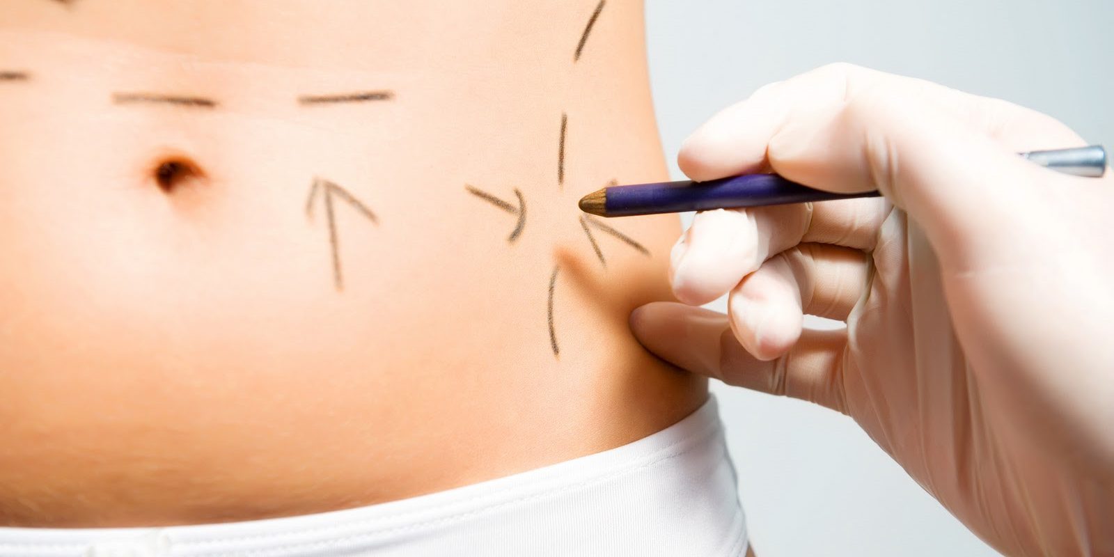 A tummy tuck