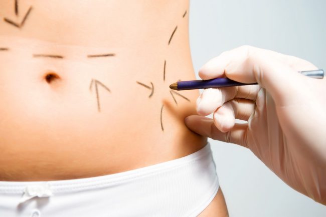 A tummy tuck