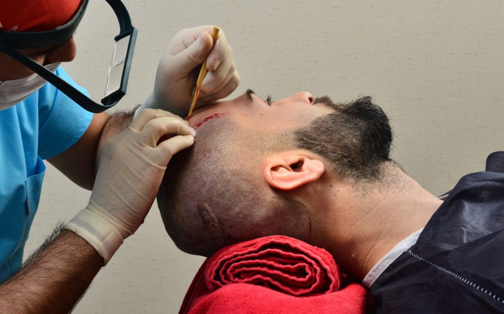 transplante-capilar foto