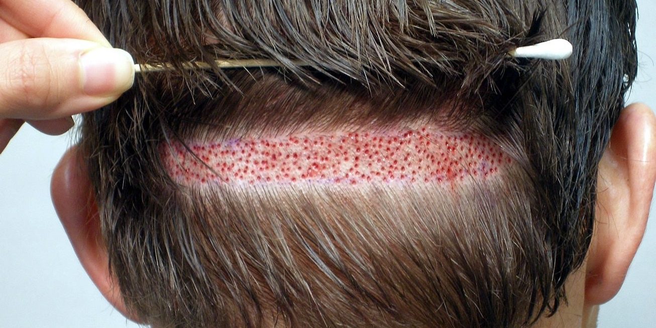 injertos capilares en Turquia - fue