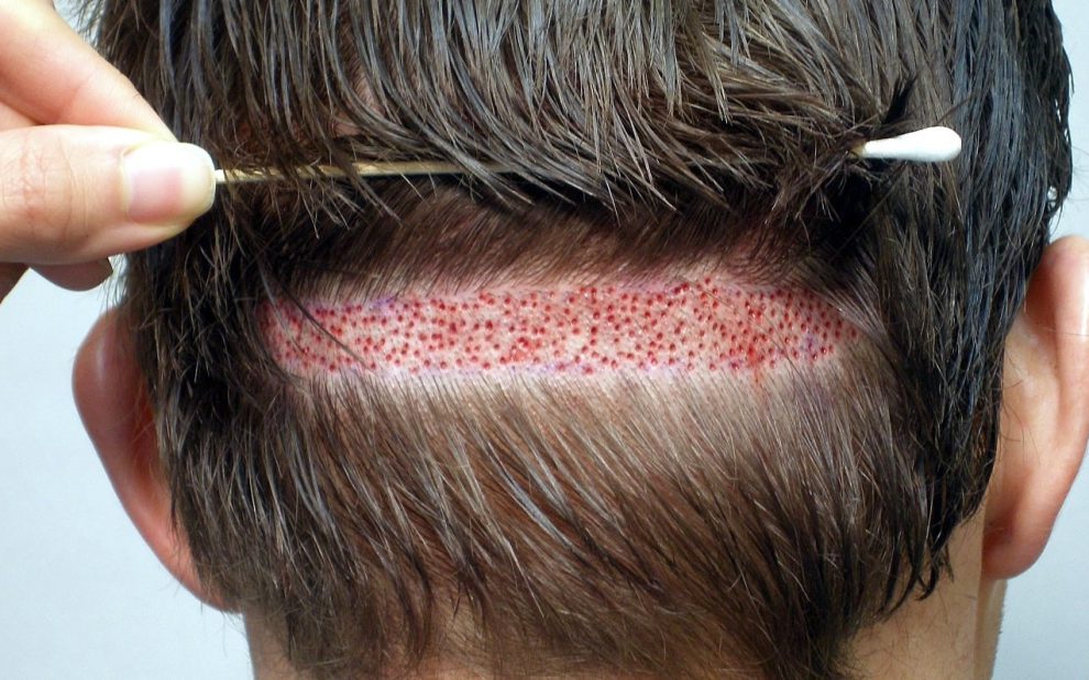 injertos capilares en Turquia - fue