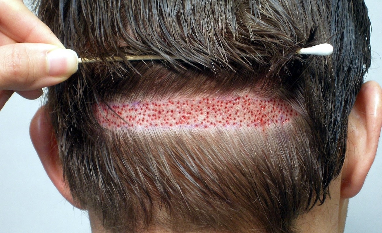 injertos capilares en Turquia - fue