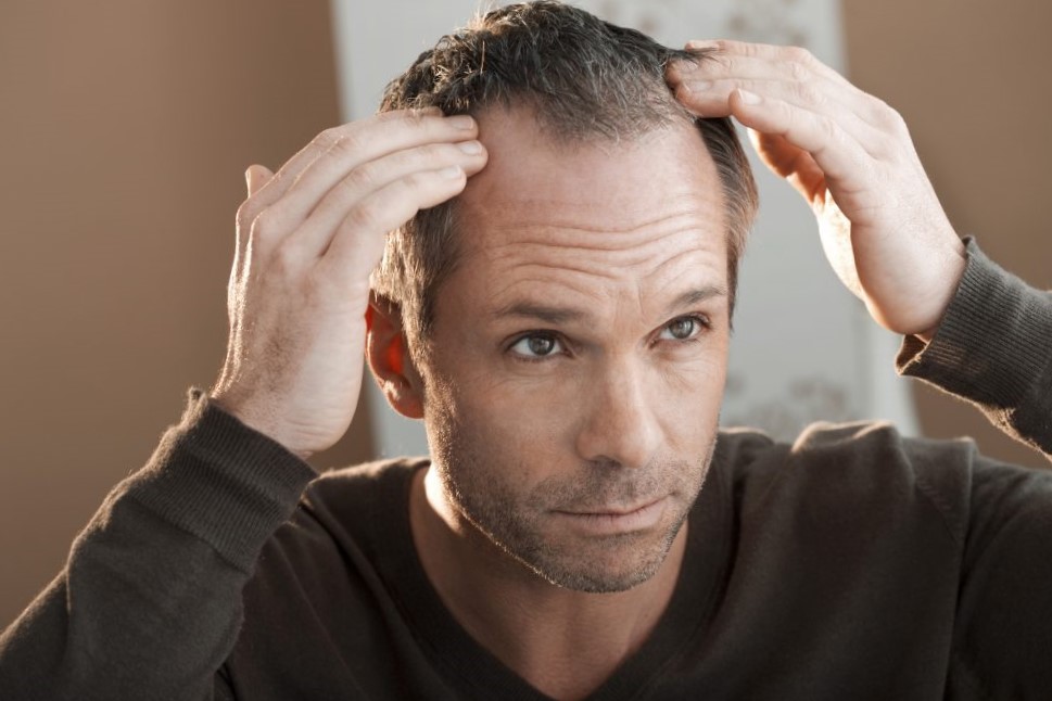 implantes capilares en España - pelo caido