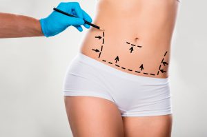 abdominoplastia en Colombia - mano doctor