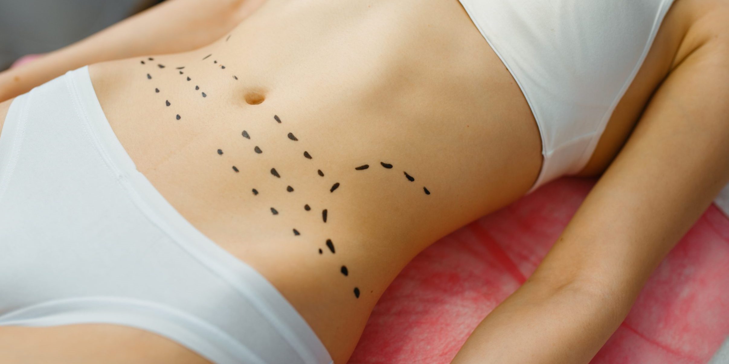 abdominoplastia en Colombia - marcas