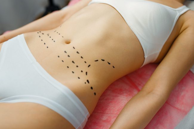 abdominoplastia en Colombia - marcas