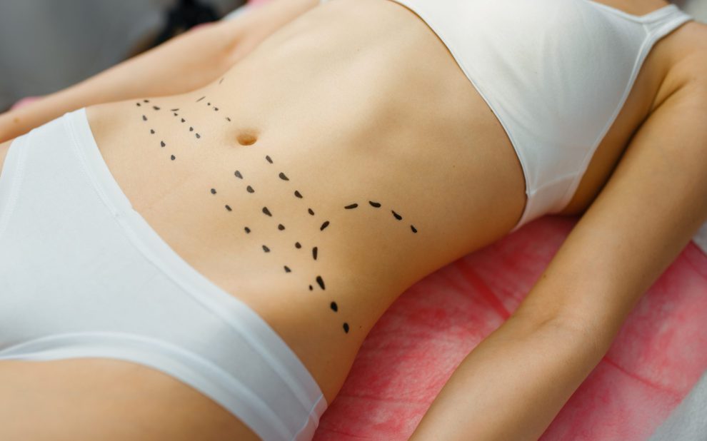 abdominoplastia en Colombia - marcas