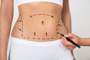 abdominoplastia en Colombia - señales