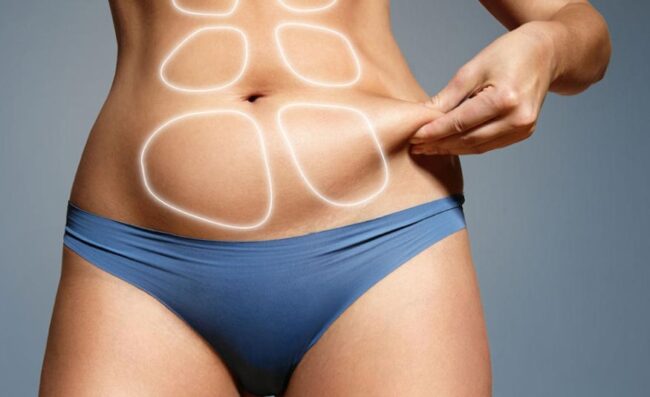 liposuccion en colombia - abdominal