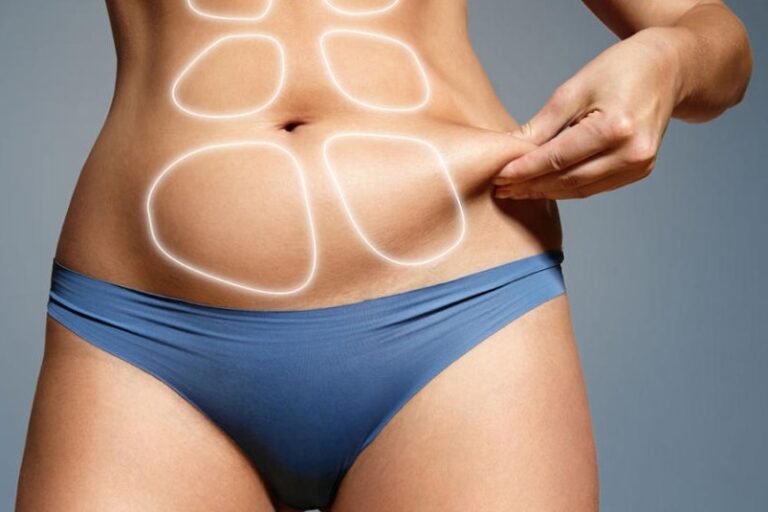 liposuccion en colombia - abdominal