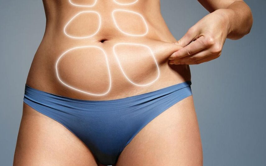 liposuccion en colombia - abdominal