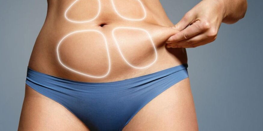 liposuccion en colombia - abdominal