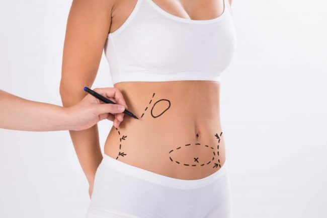 liposuccion en colombia - marcas