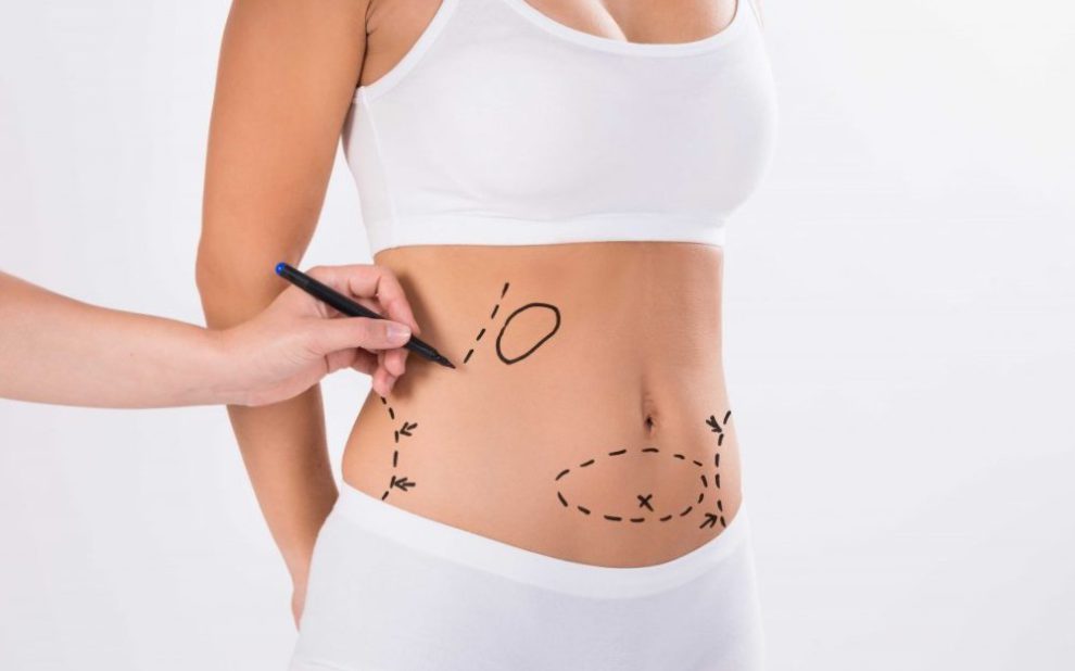 liposuccion en colombia - marcas