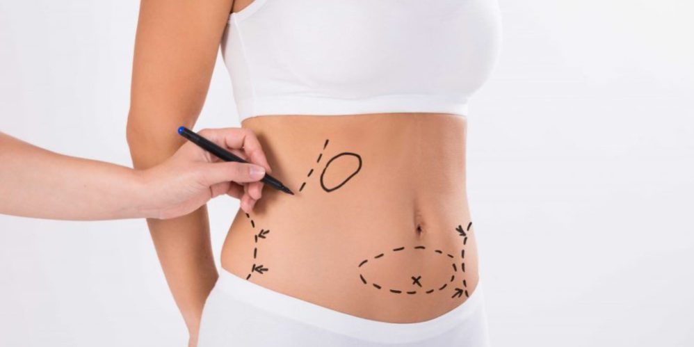 liposuccion en colombia - marcas