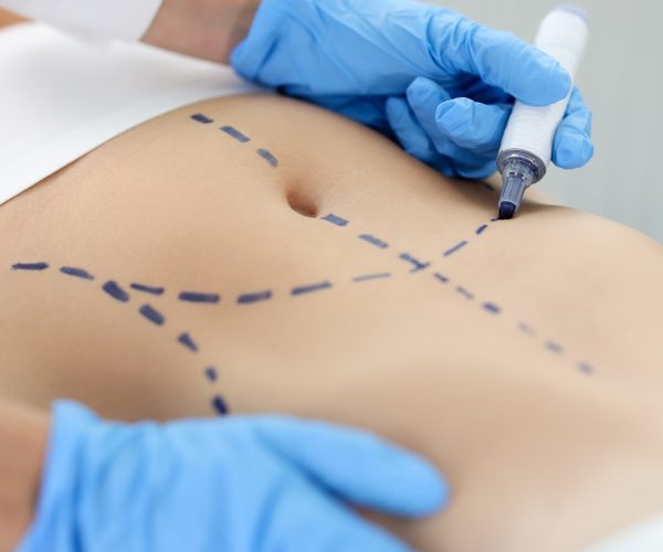 Abdominoplastia en el extranjero - liposucción