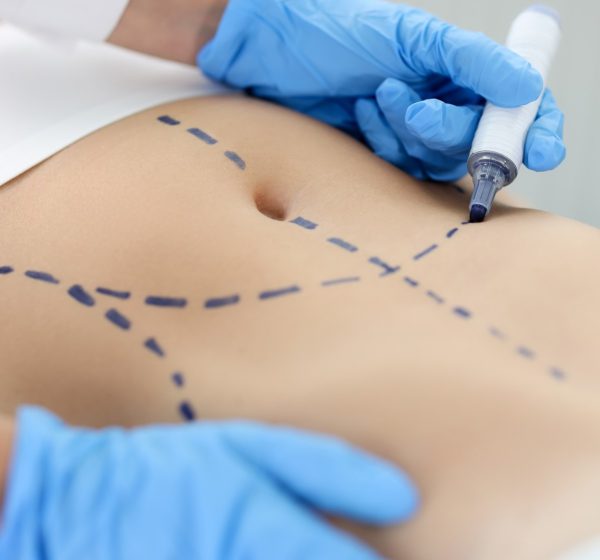 Abdominoplastia en el extranjero - liposucción