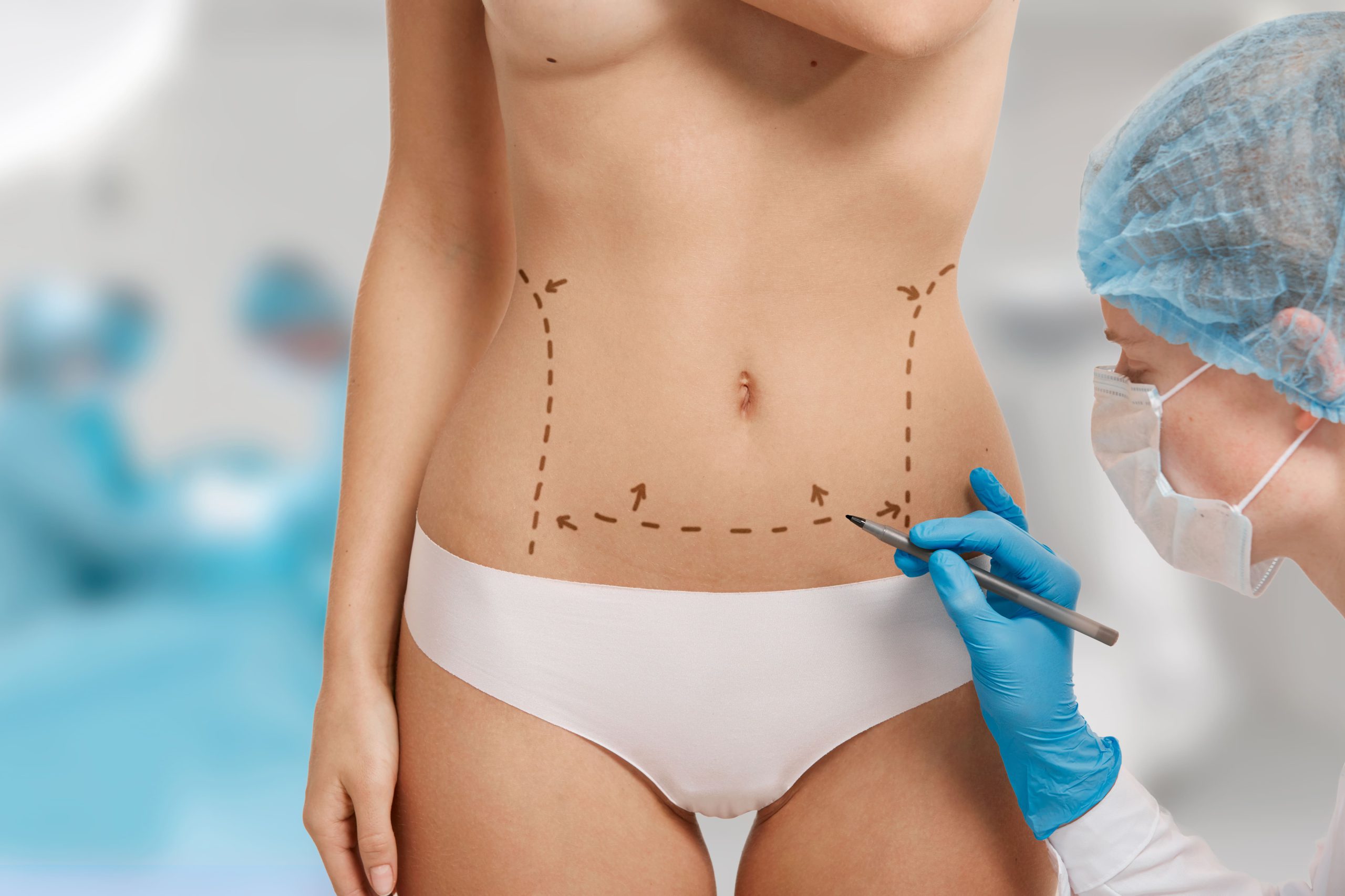 cirugía estética - abdominoplastia