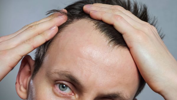 implante capilar - hombre preocupado por su pelo