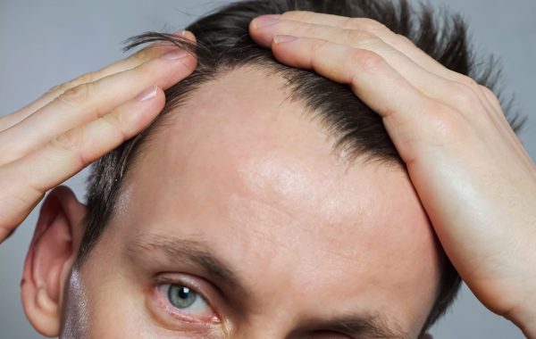 implante capilar - hombre preocupado por su pelo