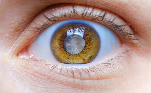 oftalmología - cataratas