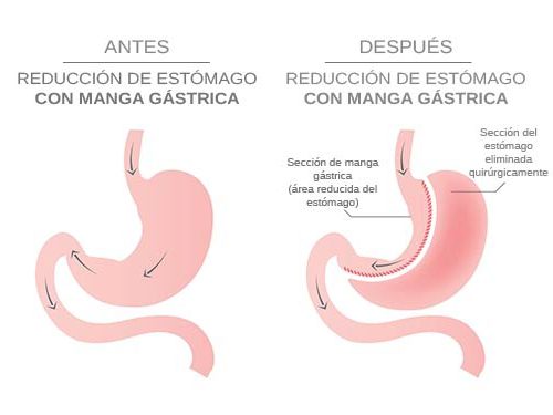 cirugía - manga gástrica