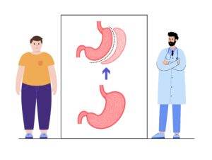 Cirugía bariátrica en Turquía -Baypass