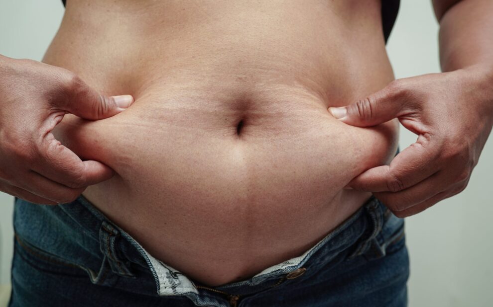 Cirugía bariátrica en Turquía -Obesidad