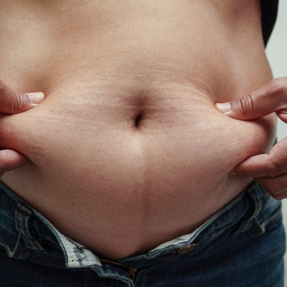 Cirugía bariátrica en Turquía -Obesidad