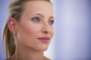 blefaroplastia en colombia - mujer ante una blefaroplastia