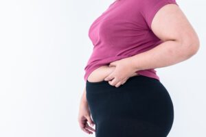 cirugía bartátrica en turquía - chica con sobrepeso