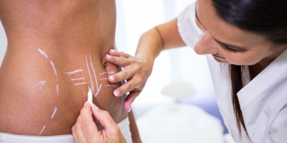 cirugía estetica en colombia - abdomen