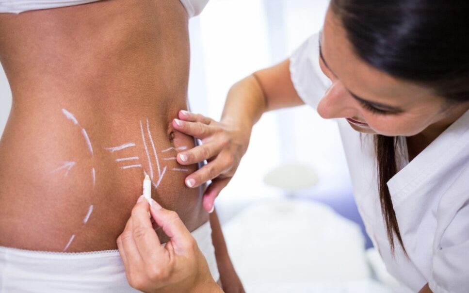 cirugía estetica en colombia - abdomen