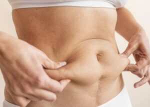 Abdominoplastia en Colombia - Grasa