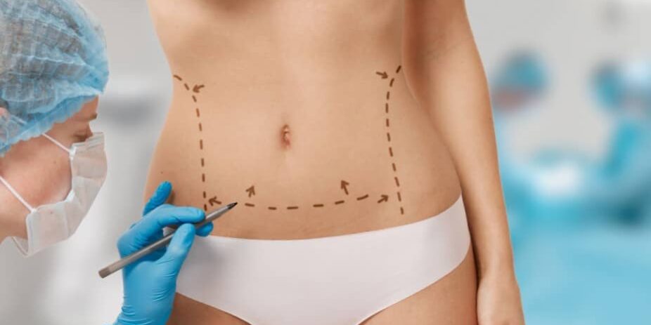Cirugía estética en Colombia - Abdomen