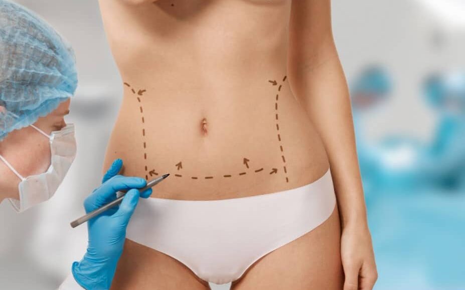 Cirugía estética en Colombia - Abdomen